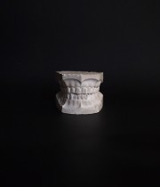 歯の石膏模型